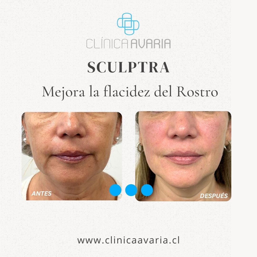 Antes y Después de Sculptra + Ácido Hialurónico en Pómulos