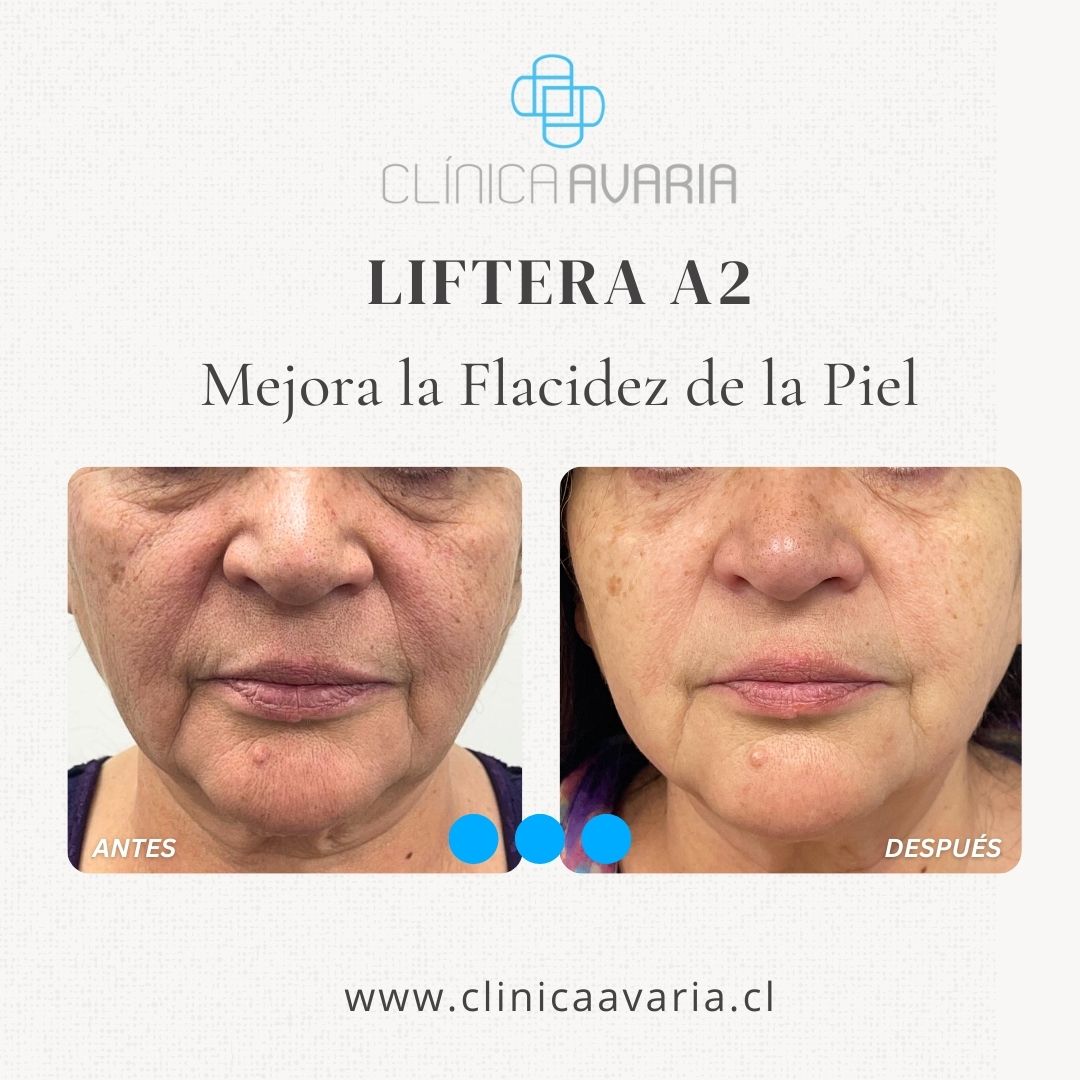 ANTES Y DESPUÉS DE HIFU
