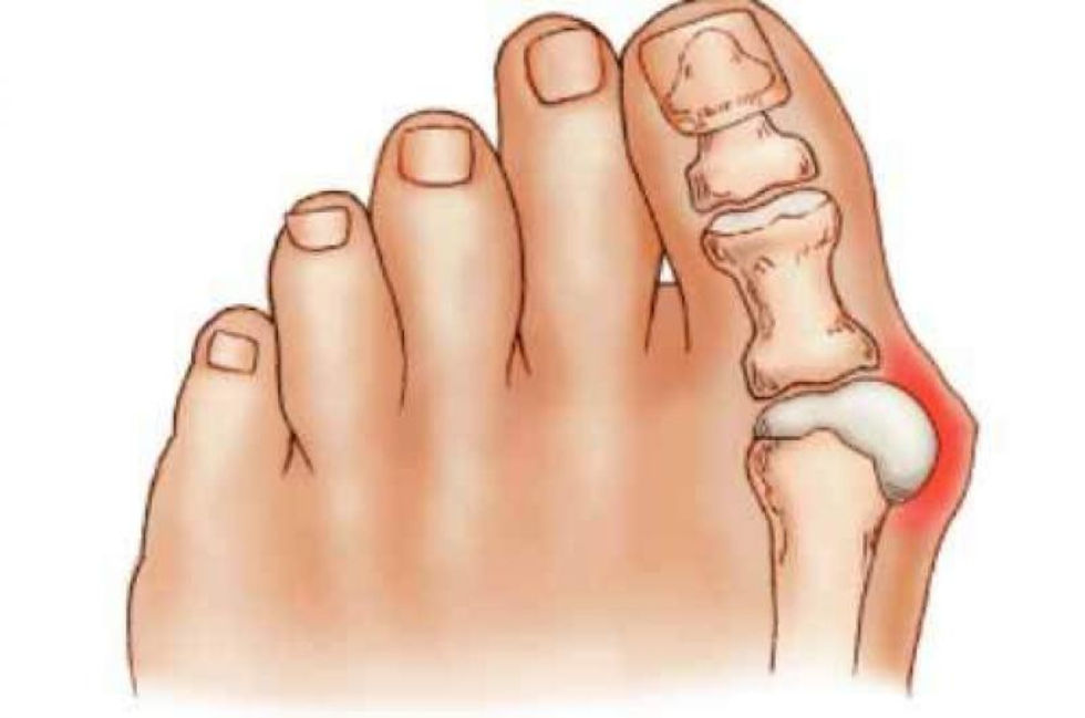 Miniatura: CORRECTOR DE JUANETE CON ALETA PROTECTORA