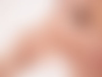 Exploring Juvederm: Dermal Fillers