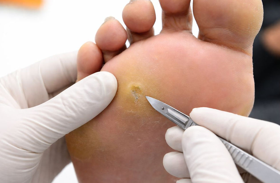 Corn and callus removal