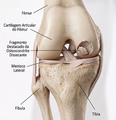 Osteocondrite_dissecante_dr_daniel_hidalgo.jpg