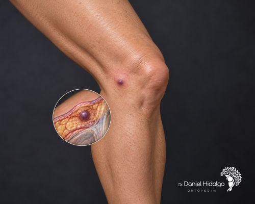 Bent leg with a spot on the knee and a zoomed-in view of an internal injury; black background, text reading "Dr. Daniel Hidalgo Ortopedia." Illustrative image.
