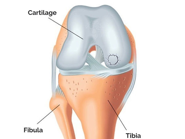 osteochondritis_dissecans_knee