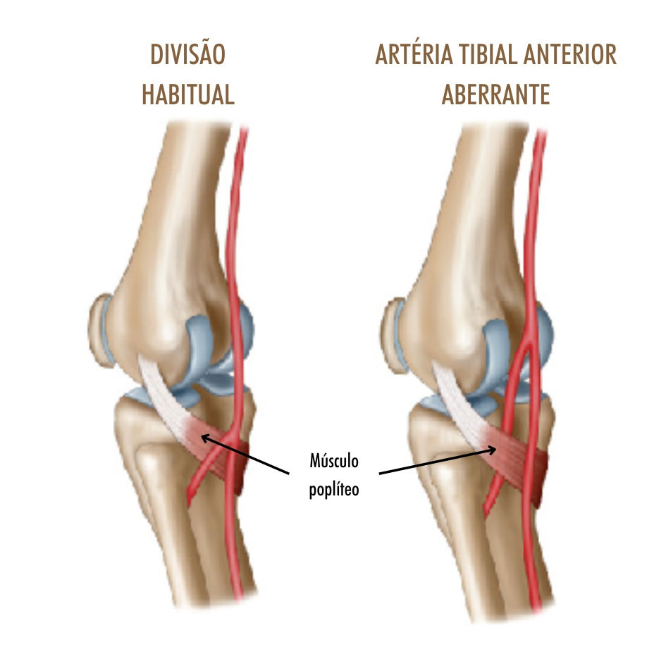 imagem ilustrativa mostrando a diferença da bifurcação habitual da artéria poplítea e da formação da artéria tibial anterior aberrante
