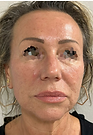 Antes y después facial
