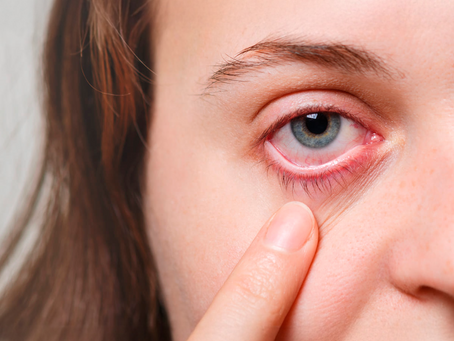 Se você suspeita de conjuntivite, não faça isso!