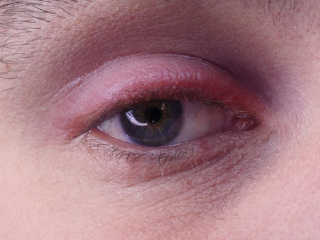 Qual a causa da blefarite?