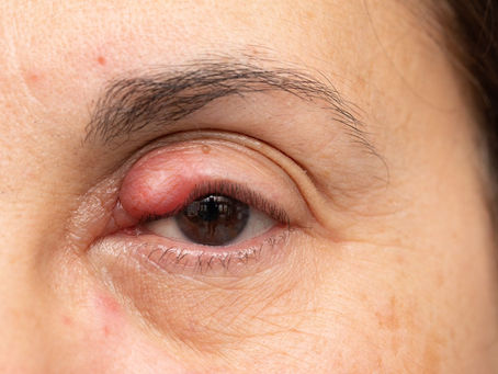 Seu terçol pode ser mais sério do que parece!