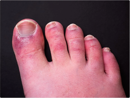 Người gout nặng cần phải lưu ý những điều gì? Cách điều trị hiệu quả