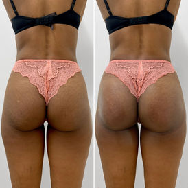 Booty_ButtVacuum_BeautyFix_2048x.jpg