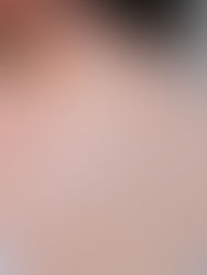 Mụn lưng là gì? Làm sao để đánh bay mụn lưng hiệu quả 