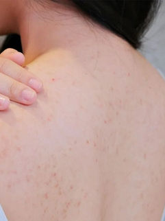 Mụn lưng là gì? Làm sao để đánh bay mụn lưng hiệu quả 