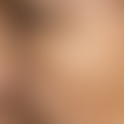 The Ultimate Guide to Pigmentation Removal: Causes, Treatments, and Prevention