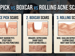 Ice Pick vs Boxcar vs Rolling Acne Scars: Which Treatment Works Best?