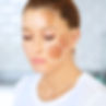 Melasma face