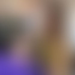 Dr Lilin performing pico laser on patient