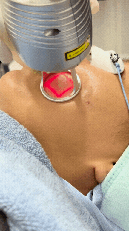 Dr lilin performing co2 laser on patient