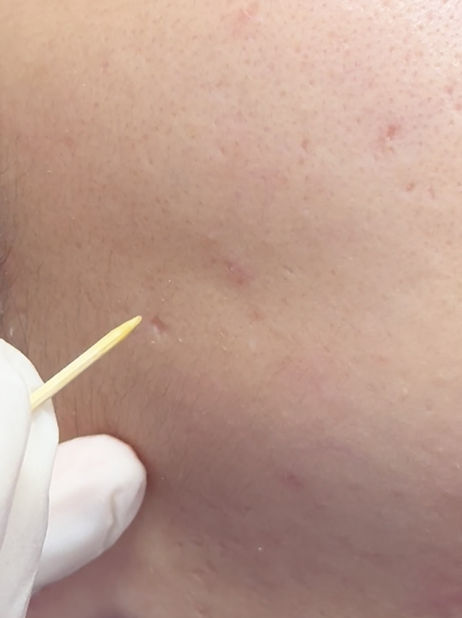 TCA Cross for acne scars