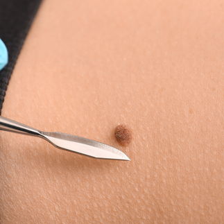 Mole Surgical Excision