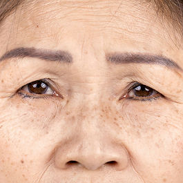 Cure Wrinkles treatment