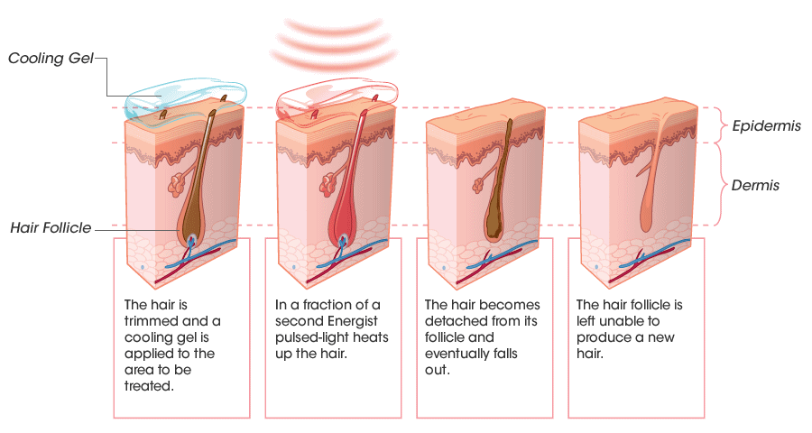 How skin and hair react to laser treatment