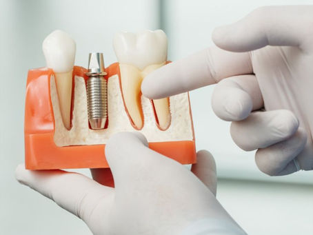 تركيبات الأسنان الثابتة: ابتسامة طبيعية وقوة مضغ ممتازة مع د. تامر وجيه