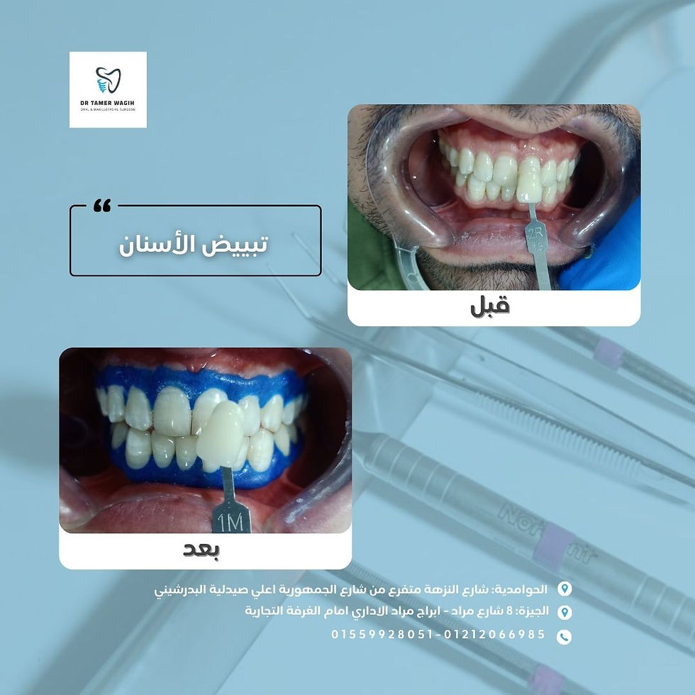 Teeth Whitening: A Difference Visible from the First Smile