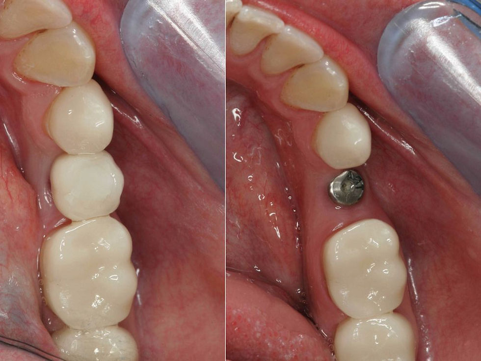 Close-up of teeth and gums in a split dental before-and-after, showing an implant screw replacing a missing tooth.