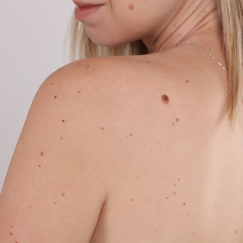 Skin Tag and Blemish Removal At Radiance Medi Spa Colchester