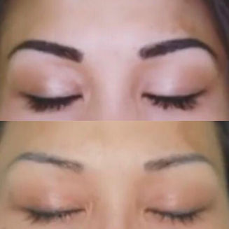 eyebrow tattoo removal, eyeliner tattoo