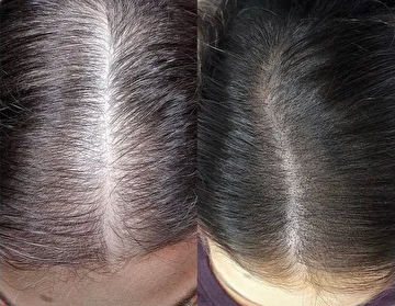 Female scalp micropigmentation