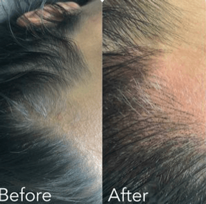 Microblading newport beach smp before and after