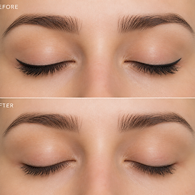 eyeliner tattoo removal at Microblading Los Angeles.png