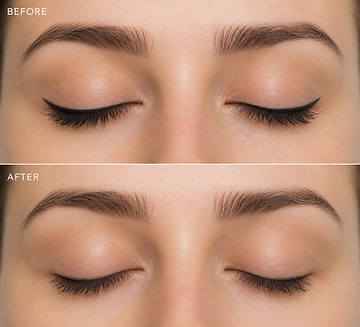 eyeliner tattoo removal at Microblading Los Angeles.png