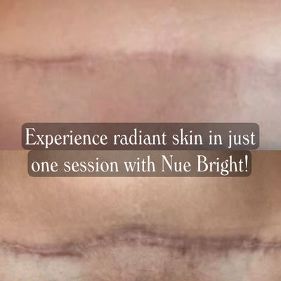 Scar Camouflage, Ink-less skin rejuvenation