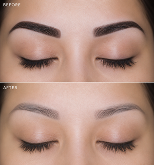 Glycolic Tattoo Removal