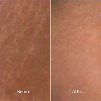 Skin Camouflage, Ink-less skin rejuvenation