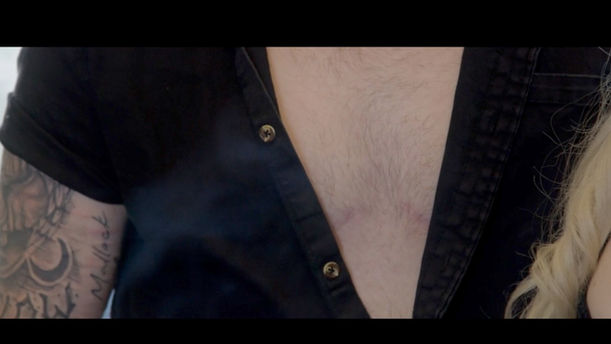 UnbrokenFilm_Zeek_Breastremoval_CloseUpScars.jpg