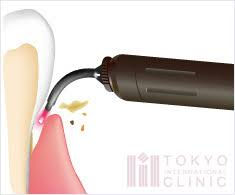 歯科用レーザー勉強会