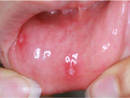 単純疱疹（herpes simplex）感染性粘膜疾患の一つ