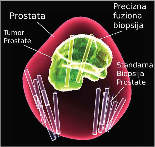 fuziona biopsija prostate urolog beograd srbija magnet pirads karcinom rak prostata lek operacija laparoskopija robot dr nikola stanojevic