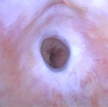 striktura uretre suženje uretre bukalna mukoza  BMG mokrenje otežano teško operacija urolog urologija beograd srbija dr nikola stanojevic prof sava perovic