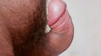 cena ugradnje penilne proteze pejronijeve bolesti cena ispravljanja penisa Coloplast titan penilna proteza implant penilni erekcija impotencija na dugme inflatabilna peronijeva pejronijeva peyronie ipp induracija penis penisa plastika kriv penis krivljenje penisa kurvatura bol čvor cvor čvorić cvoric urolog operacija ispravljanje ispravljanja dr stanojevic urolog hirurg hirurgija beograd srbija
