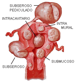 Miomatose uterina-gincologista em manaus-gincologista cassi-ginecologista AFEAM-ginecologista CONAB- ginecologia GEAP
