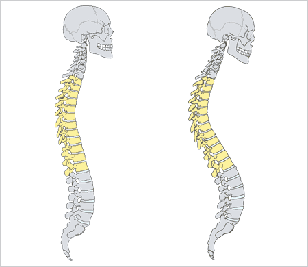 kyphosis.gif