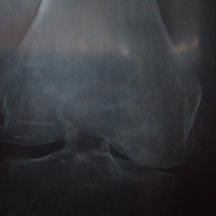OA Knees AF.jpg