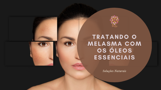 Melasma, como tratar de forma natural