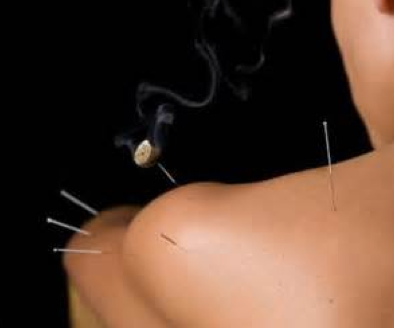Moxibustion