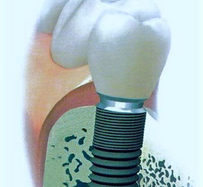 Astra+Implantat+-+Bild_edited_edited.jpg